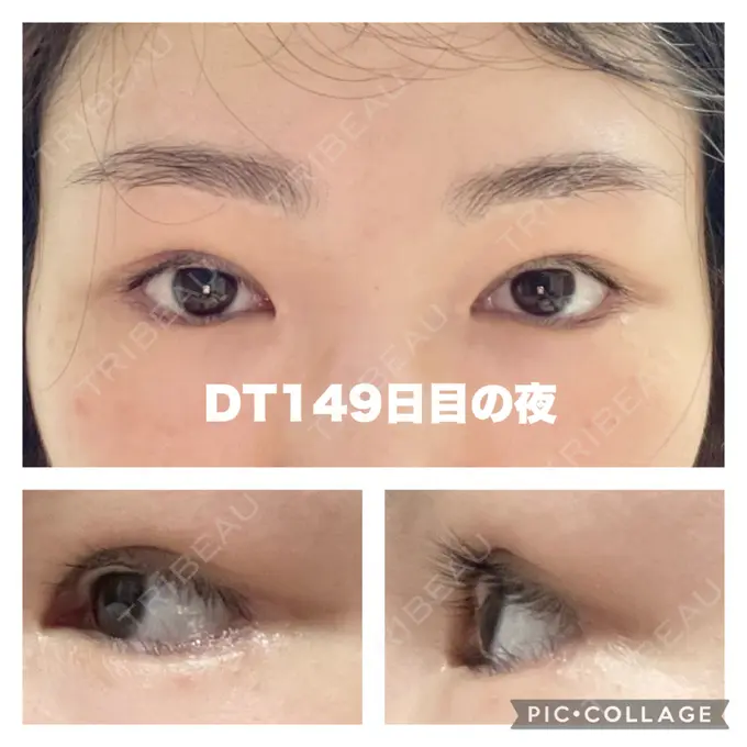 タレ目形成・グラマラスライン（切開） / 目元修正 銀座マイアミ美容外科 DAY 149 メイン用