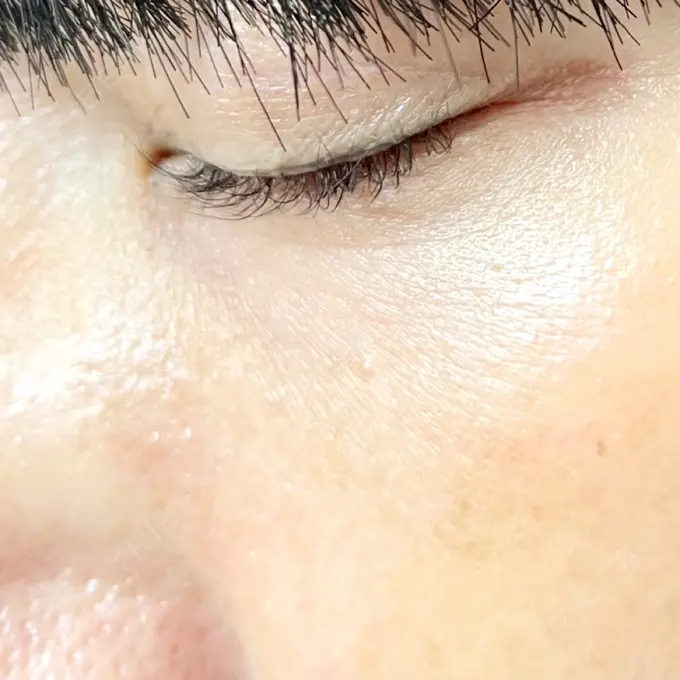 毛穴洗浄（ハイドラフェイシャルなど） / 光治療（フォトフェイシャルなど） 東京素肌クリニック 銀座本院 AFTER メイン用