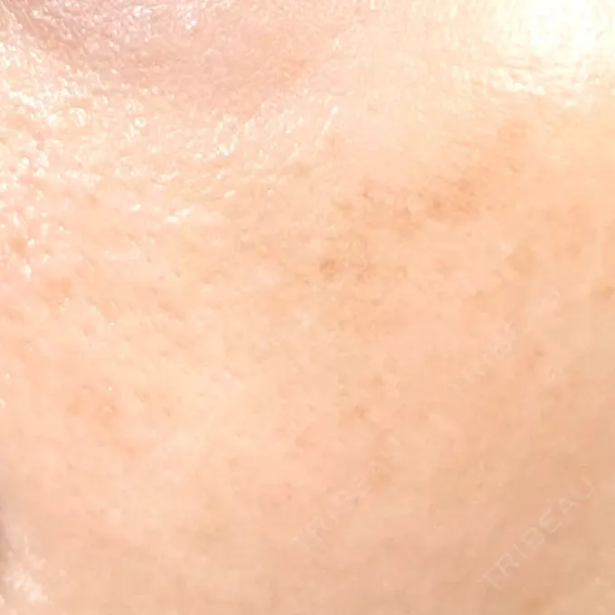 毛穴洗浄（ハイドラフェイシャルなど） / 光治療（フォトフェイシャルなど） 東京素肌クリニック 銀座本院 DAY 0 メイン用