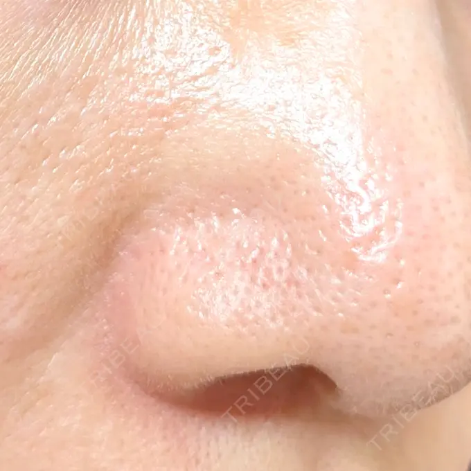 毛穴洗浄（ハイドラフェイシャルなど） / 光治療（フォトフェイシャルなど） 東京素肌クリニック 銀座本院 DAY 0 メイン用