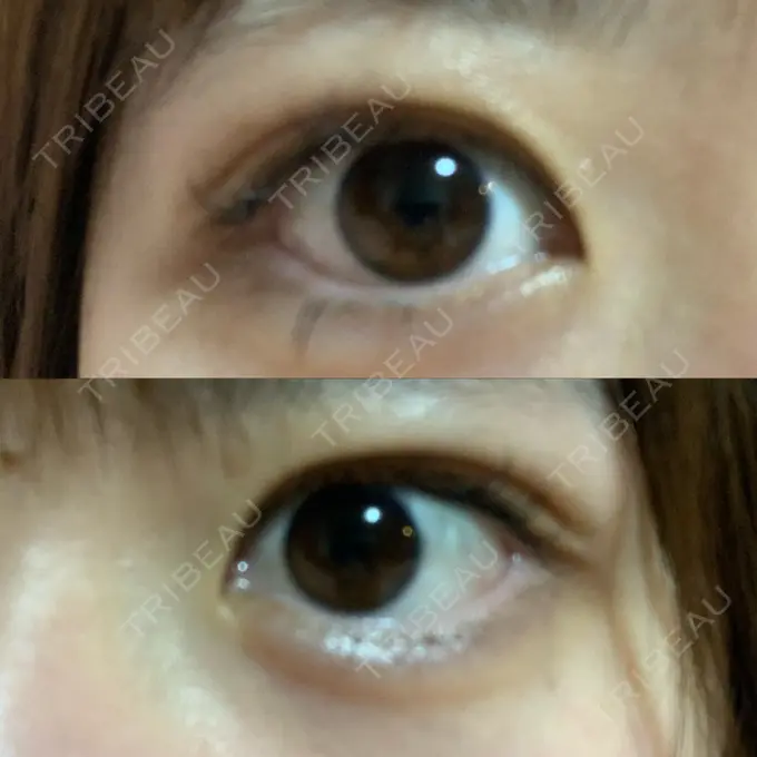 二重埋没 城本クリニック 姫路院 DAY 5 メイン用