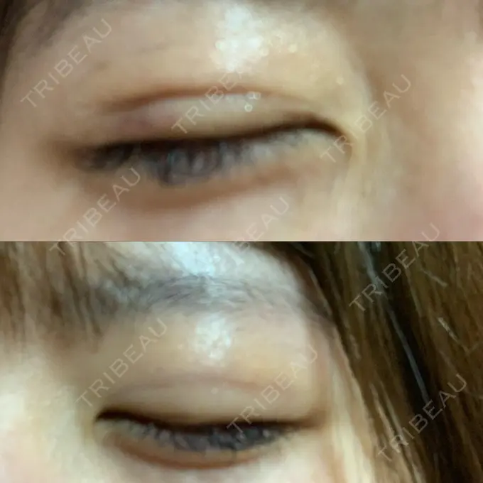 二重埋没 城本クリニック 姫路院 DAY 5 メイン用