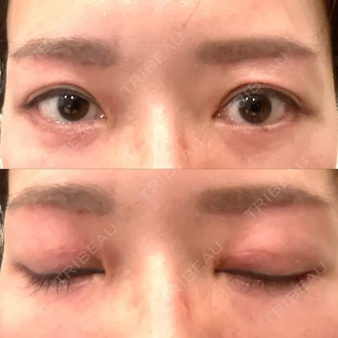 二重切開 / 眼瞼下垂（切開） / 下まぶたたるみ取り / 眉下切開 e:Top clinic（イートップクリニック） DAY 26 メイン用