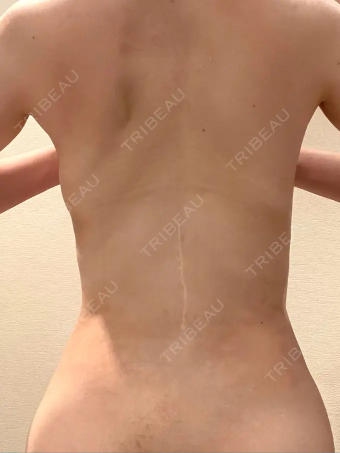 インディバ（お腹） / インディバ（腰） / インディバ（背中） WOM SALON【術後ケア取扱いサロン】 DAY 18 メイン用