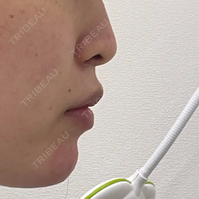 ヒアルロン酸注入（あご） 東京形成美容外科 船橋院 DAY 0 メイン用