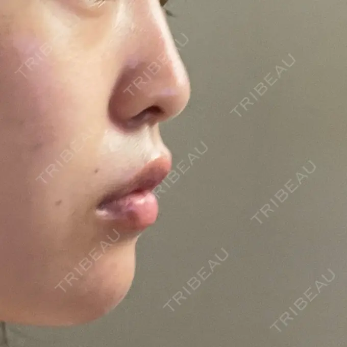 ヒアルロン酸注入（あご） 東京形成美容外科 船橋院 AFTER メイン用