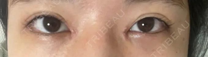 目頭切開 TCB東京中央美容外科 岡山院 DAY 5 メイン用