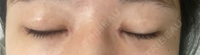 目頭切開 TCB東京中央美容外科 岡山院 DAY 5 メイン用