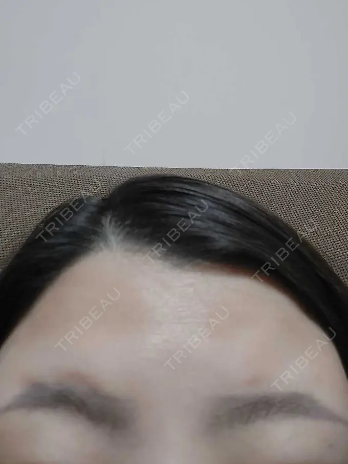 ボトックス（エラ・小顔） / ボトックス（眉間） / ボトックス（額） ルラ美容クリニック 池袋院 DAY 1 メイン用