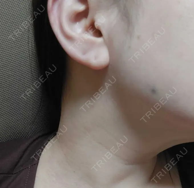 ボトックス（エラ・小顔） / ボトックス（眉間） / ボトックス（額） ルラ美容クリニック 池袋院 DAY 1 メイン用