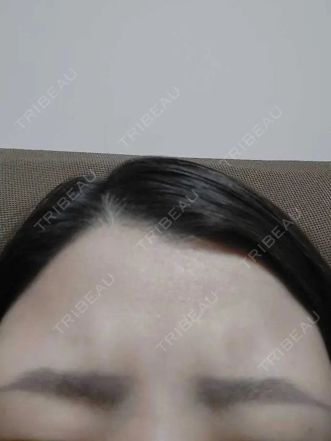 ボトックス（エラ・小顔） / ボトックス（眉間） / ボトックス（額） ルラ美容クリニック 池袋院 DAY 1 メイン用