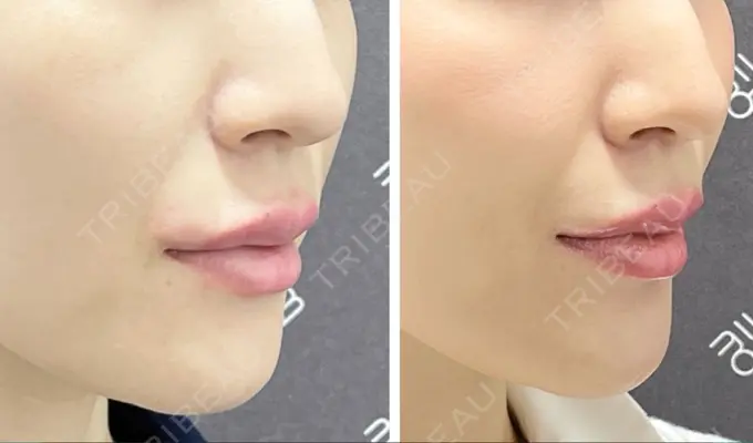 人中短縮 / ヒアルロン酸注入（唇） / ボトックス（口角） EMMO FACE CLINIC 大宮院 DAY 7 メイン用