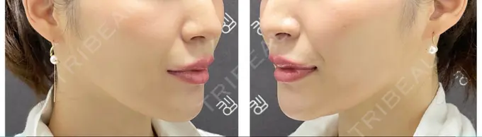 人中短縮 / ヒアルロン酸注入（唇） / ボトックス（口角） EMMO FACE CLINIC 大宮院 DAY 7 メイン用