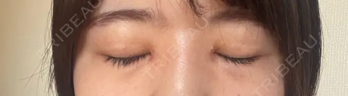 目頭切開 TCB東京中央美容外科 岡山院 DAY 6 メイン用