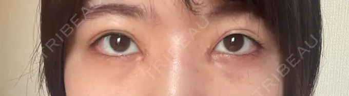 目頭切開 TCB東京中央美容外科 岡山院 DAY 6 メイン用