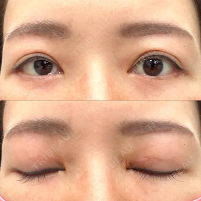 二重切開 / 眼瞼下垂（切開） / 下まぶたたるみ取り / 眉下切開 e:Top clinic（イートップクリニック） DAY 28 メイン用