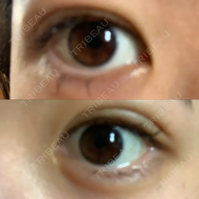 二重埋没 城本クリニック 姫路院 AFTER メイン用