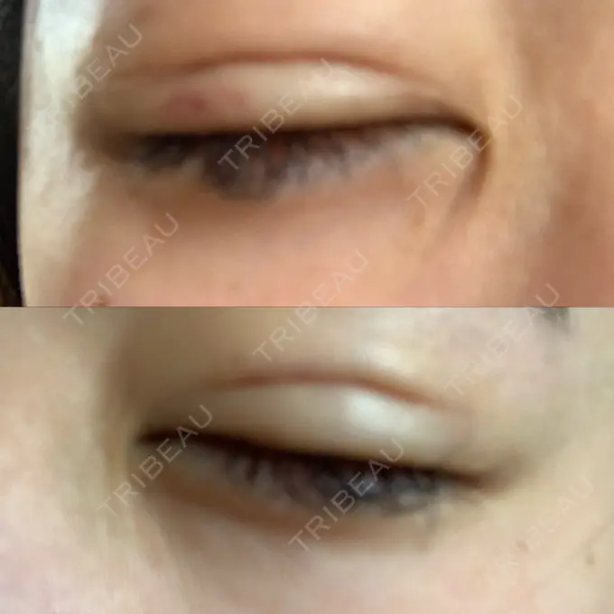 二重埋没 城本クリニック 姫路院 DAY 7 メイン用