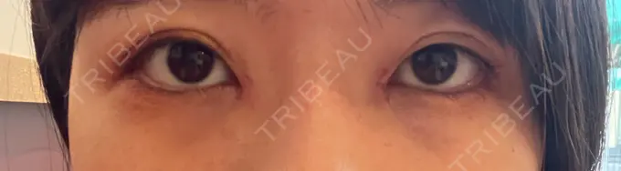 目頭切開 TCB東京中央美容外科 岡山院 AFTER メイン用