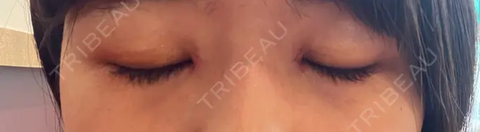 目頭切開 TCB東京中央美容外科 岡山院 DAY 6 メイン用