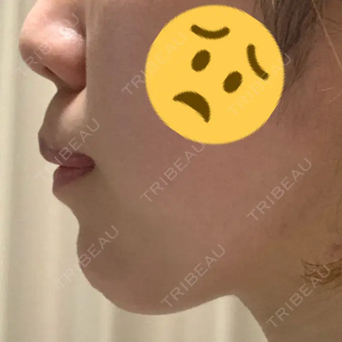 あごプロテーゼ / ヒアルロン酸注入（鼻） WOM CLINIC GINZA （ワム クリニック ギンザ） DAY 18 メイン用