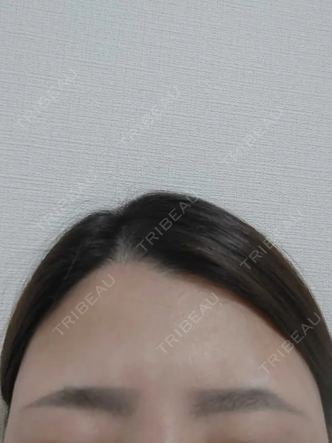 ボトックス（エラ・小顔） / ボトックス（眉間） / ボトックス（額） ルラ美容クリニック 池袋院 DAY 2 メイン用