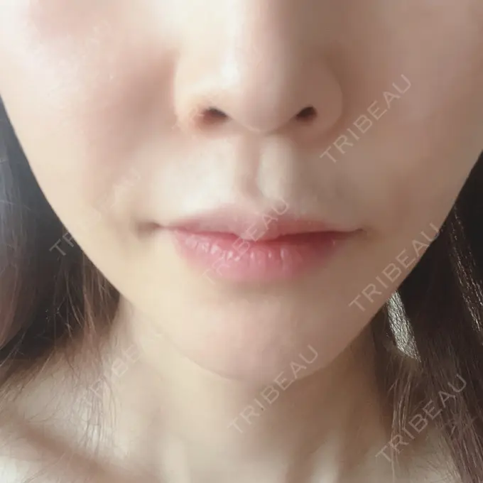 糸リフト / 脂肪吸引（顔） / ヒアルロン酸注入（額） 東京ミッドクリニック AFTER メイン用