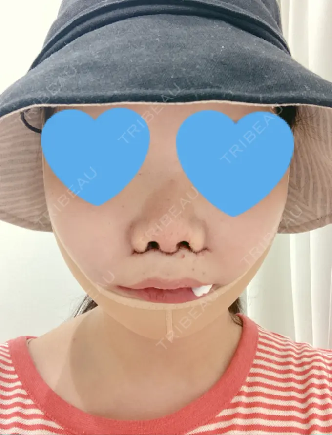 目頭切開 / 小鼻縮小（切開） / バッカルファット除去 / 脂肪吸引（顔） / 人中短縮 / ボトックス（ガミースマイル） / その他（鼻） / その他（口元） ルラ美容クリニック 名古屋本院 DAY 0 メイン用