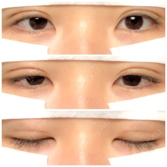 二重埋没 湘南美容クリニック 長野院 DAY 3 メイン用