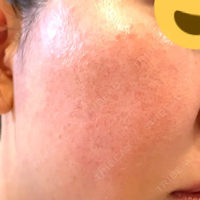 レーザートーニング（美白・肝斑） シェリークリニック 新宿本院 DAY 7 メイン用