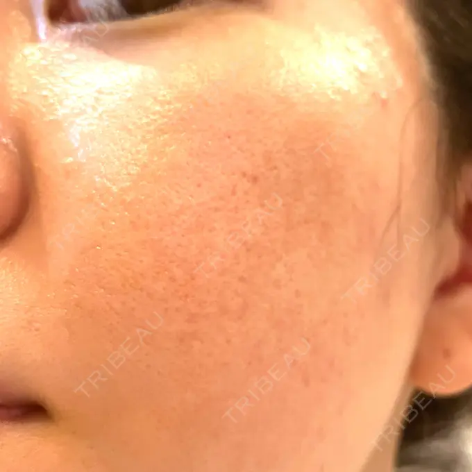 レーザートーニング（美白・肝斑） シェリークリニック 新宿本院 DAY 10 メイン用