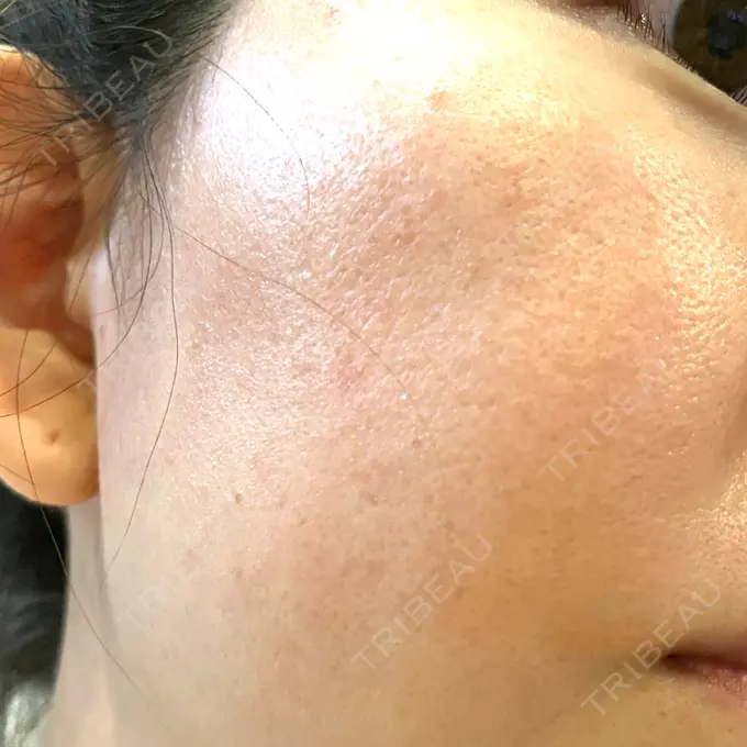 レーザートーニング（美白・肝斑） シェリークリニック 新宿本院 DAY 10 メイン用