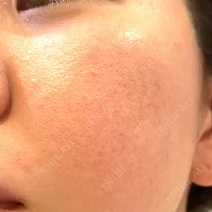 レーザートーニング（美白・肝斑） シェリークリニック 新宿本院 DAY 15 メイン用