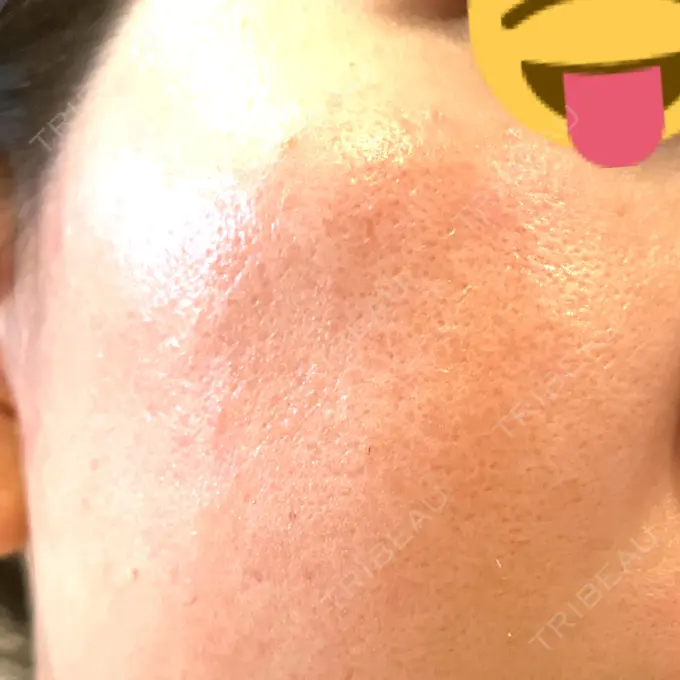 レーザートーニング（美白・肝斑） シェリークリニック 新宿本院 DAY 15 メイン用