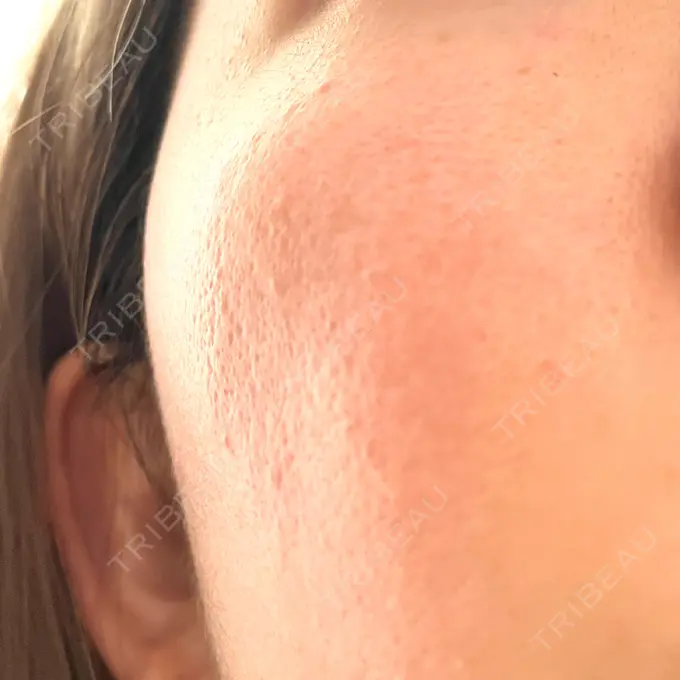 レーザートーニング（美白・肝斑） シェリークリニック 新宿本院 DAY 18 メイン用