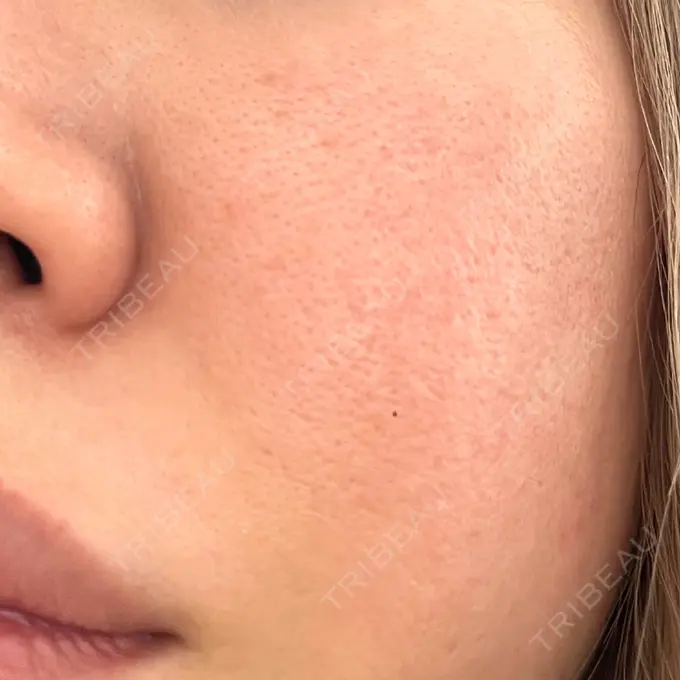 レーザートーニング（美白・肝斑） シェリークリニック 新宿本院 DAY 18 メイン用