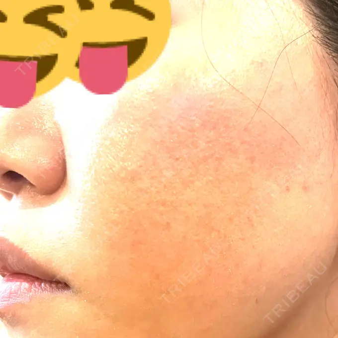 レーザートーニング（美白・肝斑） シェリークリニック 新宿本院 AFTER メイン用