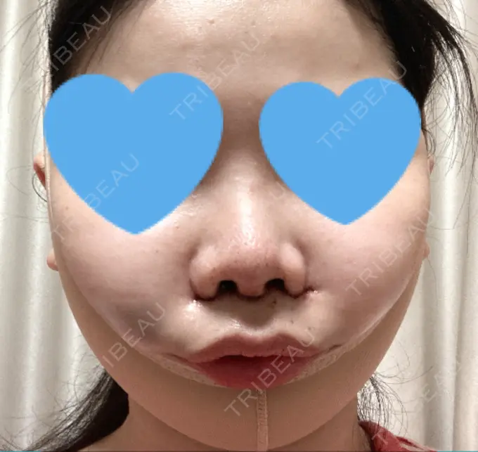 目頭切開 / 小鼻縮小（切開） / バッカルファット除去 / 脂肪吸引（顔） / 人中短縮 / ボトックス（ガミースマイル） / その他（鼻） / その他（口元） ルラ美容クリニック 名古屋本院 DAY 1 メイン用