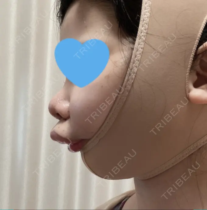 目頭切開 / 小鼻縮小（切開） / バッカルファット除去 / 脂肪吸引（顔） / 人中短縮 / ボトックス（ガミースマイル） / その他（鼻） / その他（口元） ルラ美容クリニック 名古屋本院 DAY 1 メイン用