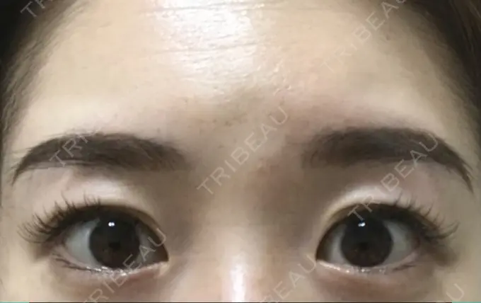 二重切開 有楽町高野美容クリニック DAY 181 メイン用