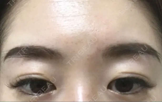 二重切開 有楽町高野美容クリニック DAY 181 メイン用