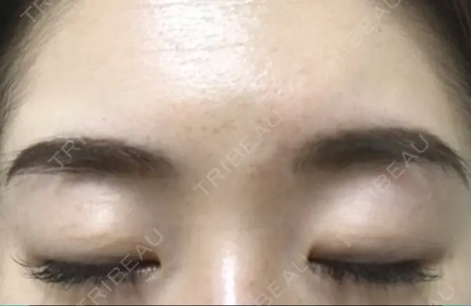 二重切開 有楽町高野美容クリニック DAY 181 メイン用