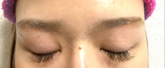 上まぶたの脂肪取り / 眉下切開 e:Top clinic（イートップクリニック） DAY 18 メイン用