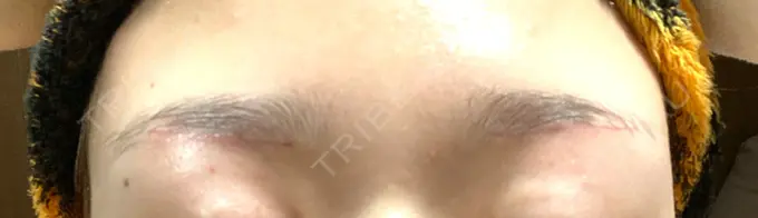 上まぶたの脂肪取り / 眉下切開 e:Top clinic（イートップクリニック） DAY 19 メイン用