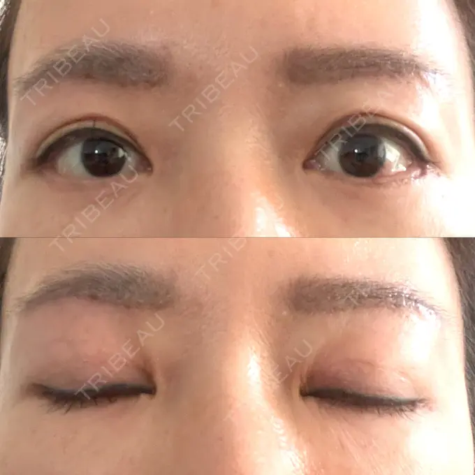 二重切開 / 眼瞼下垂（切開） / 下まぶたたるみ取り / 眉下切開 e:Top clinic（イートップクリニック） DAY 33 メイン用