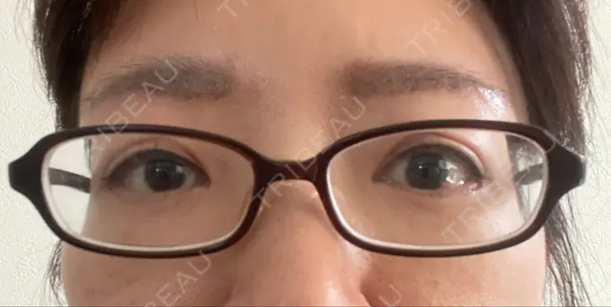 二重切開 / 眼瞼下垂（切開） / 下まぶたたるみ取り / 眉下切開 e:Top clinic（イートップクリニック） DAY 33 メイン用