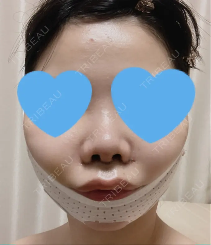 目頭切開 / 小鼻縮小（切開） / バッカルファット除去 / 脂肪吸引（顔） / 人中短縮 / ボトックス（ガミースマイル） / その他（鼻） / その他（口元） ルラ美容クリニック 名古屋本院 DAY 4 メイン用