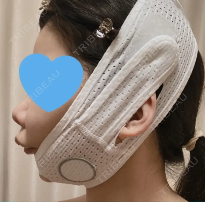 目頭切開 / 小鼻縮小（切開） / バッカルファット除去 / 脂肪吸引（顔） / 人中短縮 / ボトックス（ガミースマイル） / その他（鼻） / その他（口元） ルラ美容クリニック 名古屋本院 DAY 4 メイン用