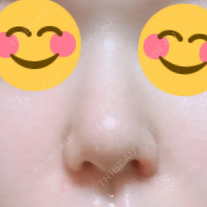 鼻孔縁挙上 シエルクリニック DAY 11 メイン用