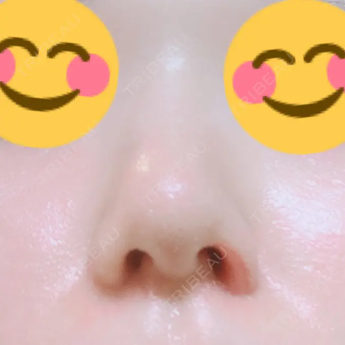 鼻孔縁挙上 シエルクリニック DAY 11 メイン用